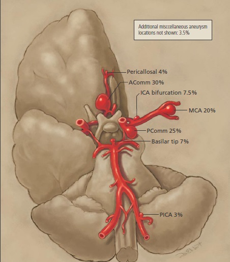 What are common signs of an aneurysm?