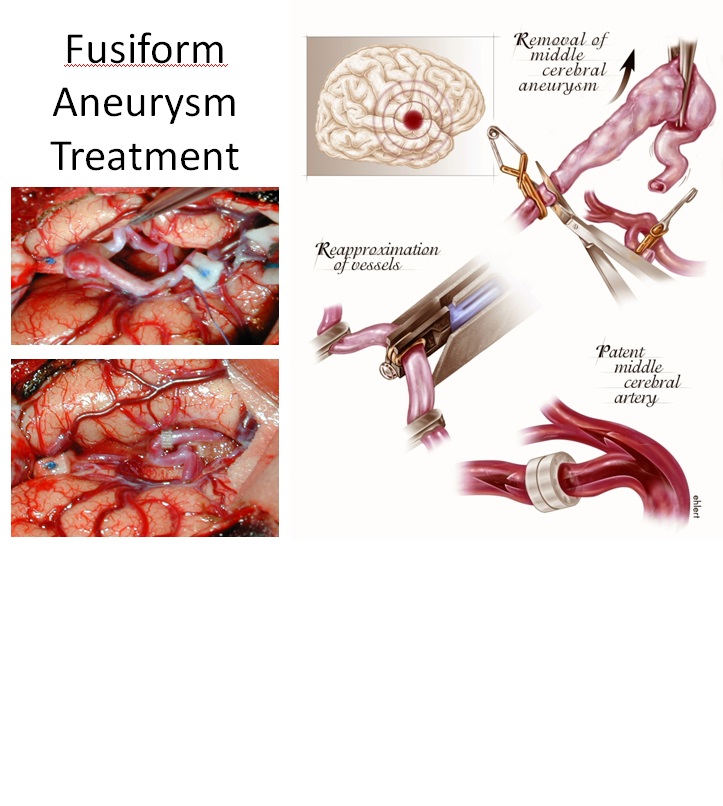 Brain Aneurysm | Cerebral Aneurysm - SeattleNeurosciences.com
