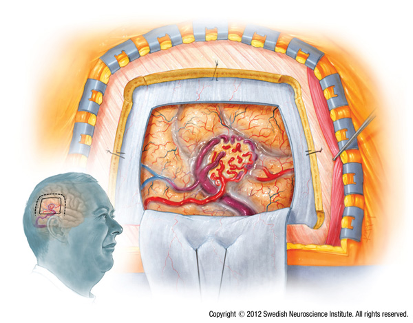 Arteriovenous Malformation AVM - SeattleNeurosciences.com