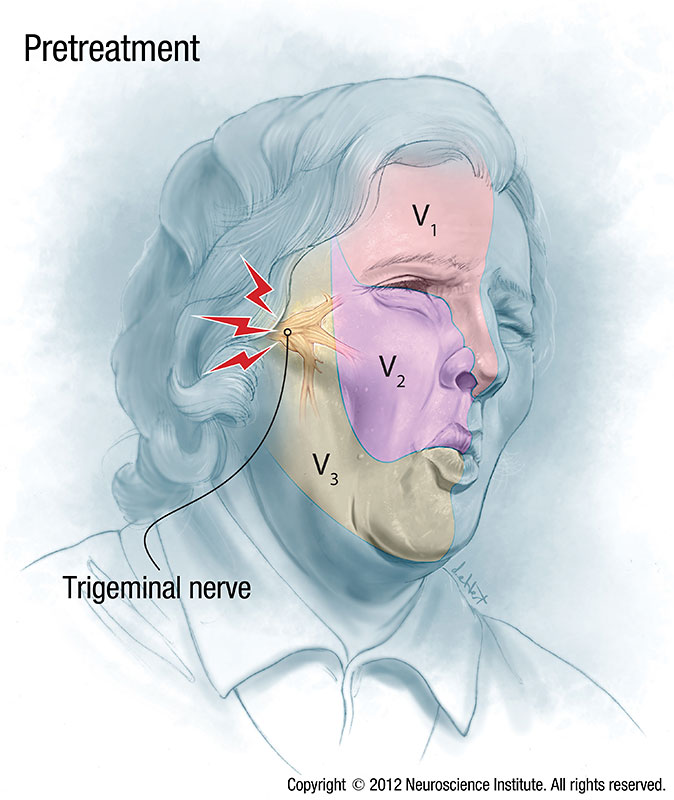 Trigeminal Neuralgia Treatment 