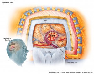 Surgical  Removal of Brain Arteriovenous Malformation or AVM